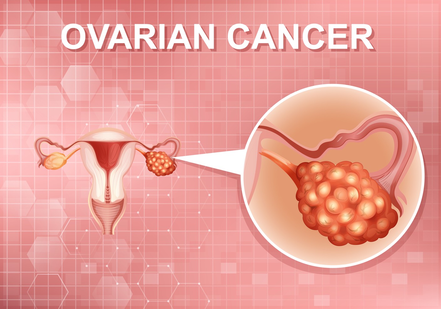 Recognising early symptoms of ovarian cancer